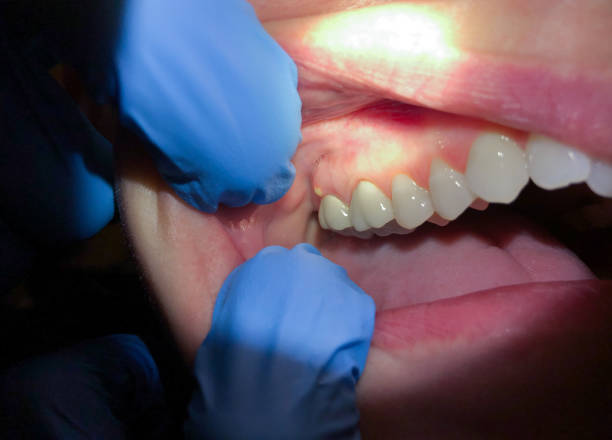 Best Emergency Treatment for Toothache in Marshfield, MO